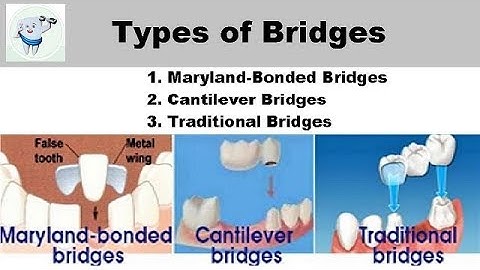 Types Of Dental Bridges