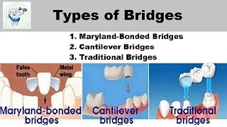 Types Of Dental Bridges