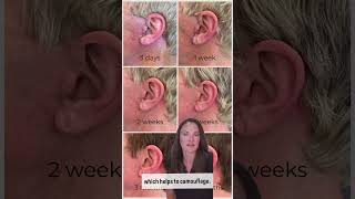 How facelift incisions are hidden to minimize visibility