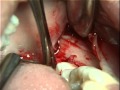 Removal of an impacted wisdom toothhorizontal impaction 1