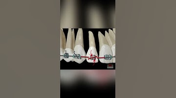 Second order Z-fold - ORTHODONTIC TIPS #Shorts