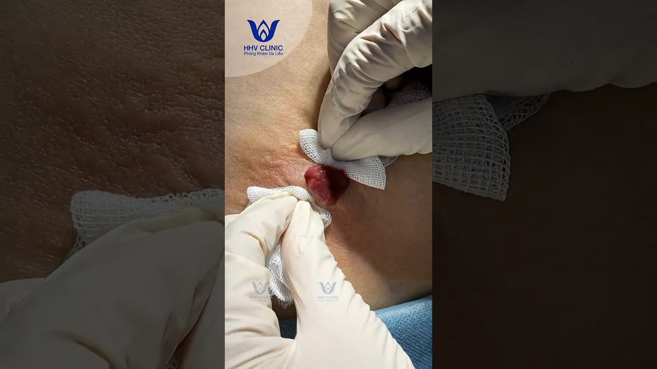 Ca mụn nhọt vùng mông khó.