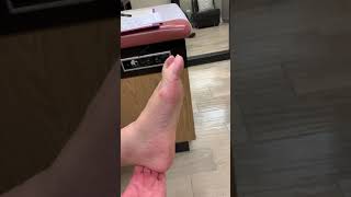 Foot Drop - Patient 1 - 5 Months Post-Op