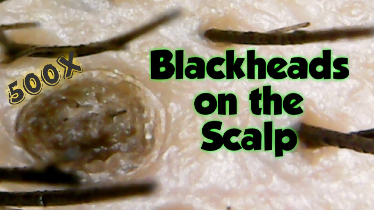 Blackheads Removal On The Scalp close Up 500x YouTube Blackheads Removal On The Scalp close Up 500x YouTube