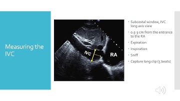 Echo Estimation of Right Atrial Pressure