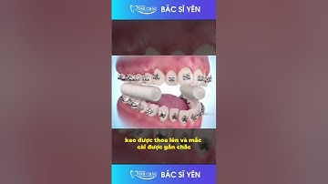 Cận Cảnh Quá Trình Gắn Mắc Cài Khi Niềng Răng