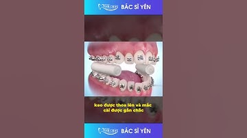 Cận Cảnh Quá Trình Gắn Mắc Cài Khi Niềng Răng
