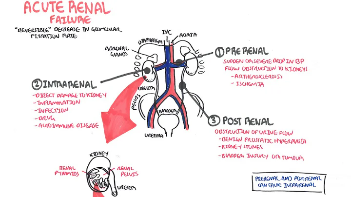 Acute Renal Failure