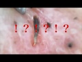 【角栓？】いちご鼻から変な感じの生えたんだけど？ｗｗｗ[Keratin plug]