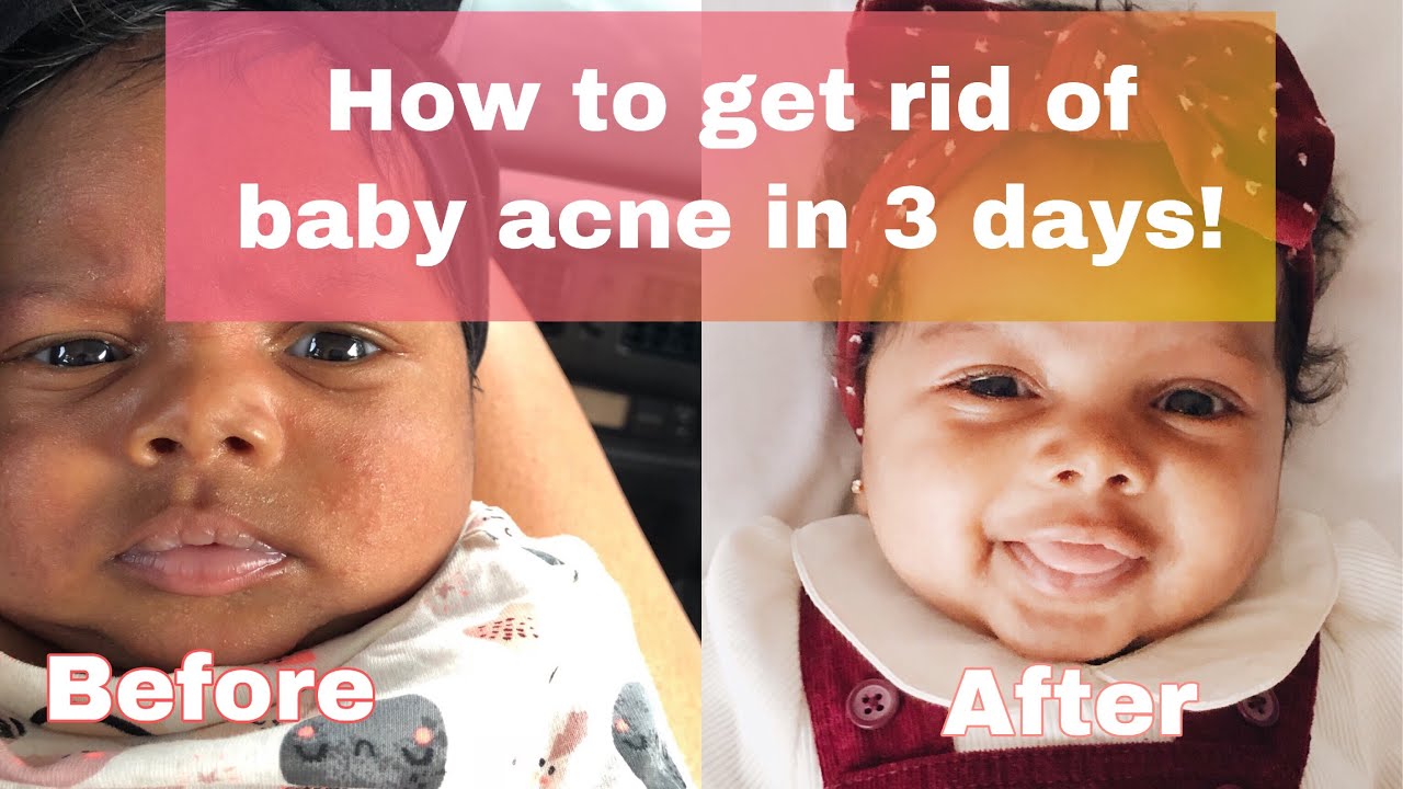 How To Get Rid Of Baby Acne In Under 3 Days Youtube