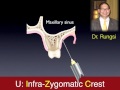 OBS-4. Infra-Zygomatic Crest