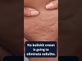 Cellulite Day – September 5th