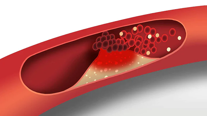 Cholesterol animation | Heart disease risk factors - DayDayNews