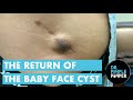 The Return of the Baby Face Cyst