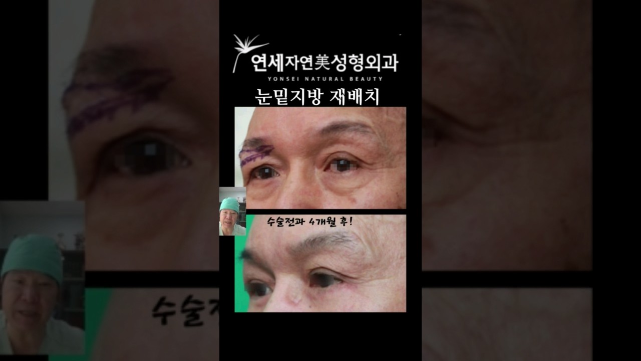 눈밑 지방재배치 4개월 후 결과는?
