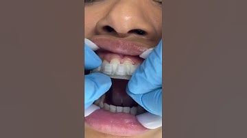 Putting 3D Printed Custom LightForce Braces On