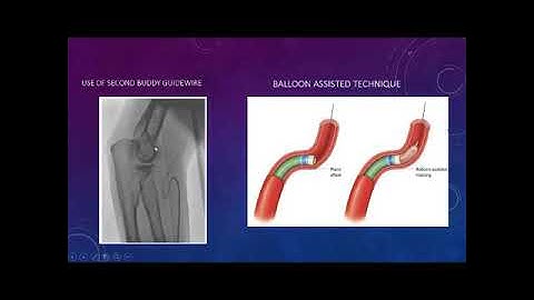 Radial artery loop: management