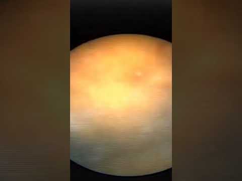 تفتيت واستخراج حصوه مع اكتشاف وجود شاش فى المثانه من 10 سنوات