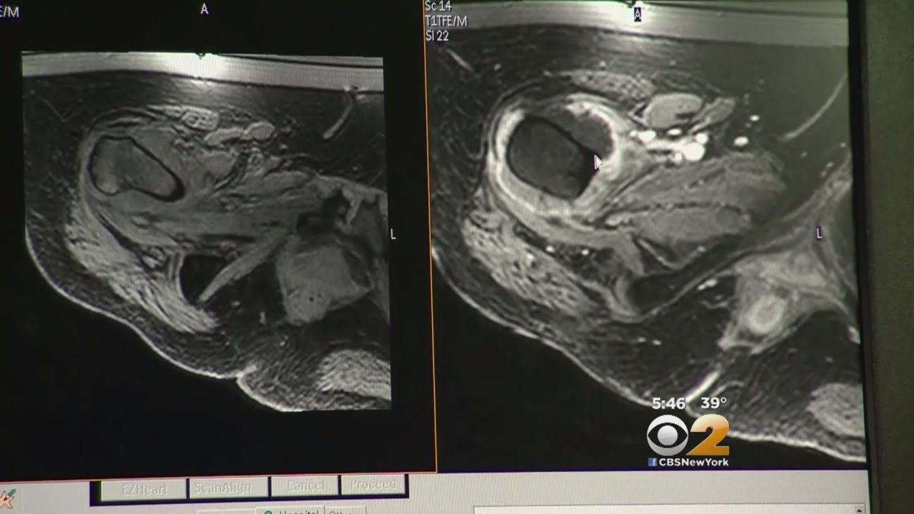 Relieving Bone Cancer Pain YouTube