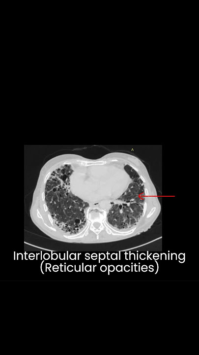 UIP- Usual Interstitial pneumonia. Idiopathic pulmonary fibrosis l Interstitial lung disease l HRCT