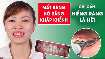 Điều trị răng hô, khấp khểnh, thiếu răng bằng phương pháp niềng răng như thế nào ?