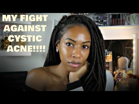 MY FIGHT AGAINST CYSTIC ACNE (HORMONAL ACNE)| NicReNoonBeauty