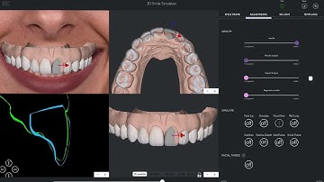 Smilefy 4.2 Demo - 3D Smile Simulation