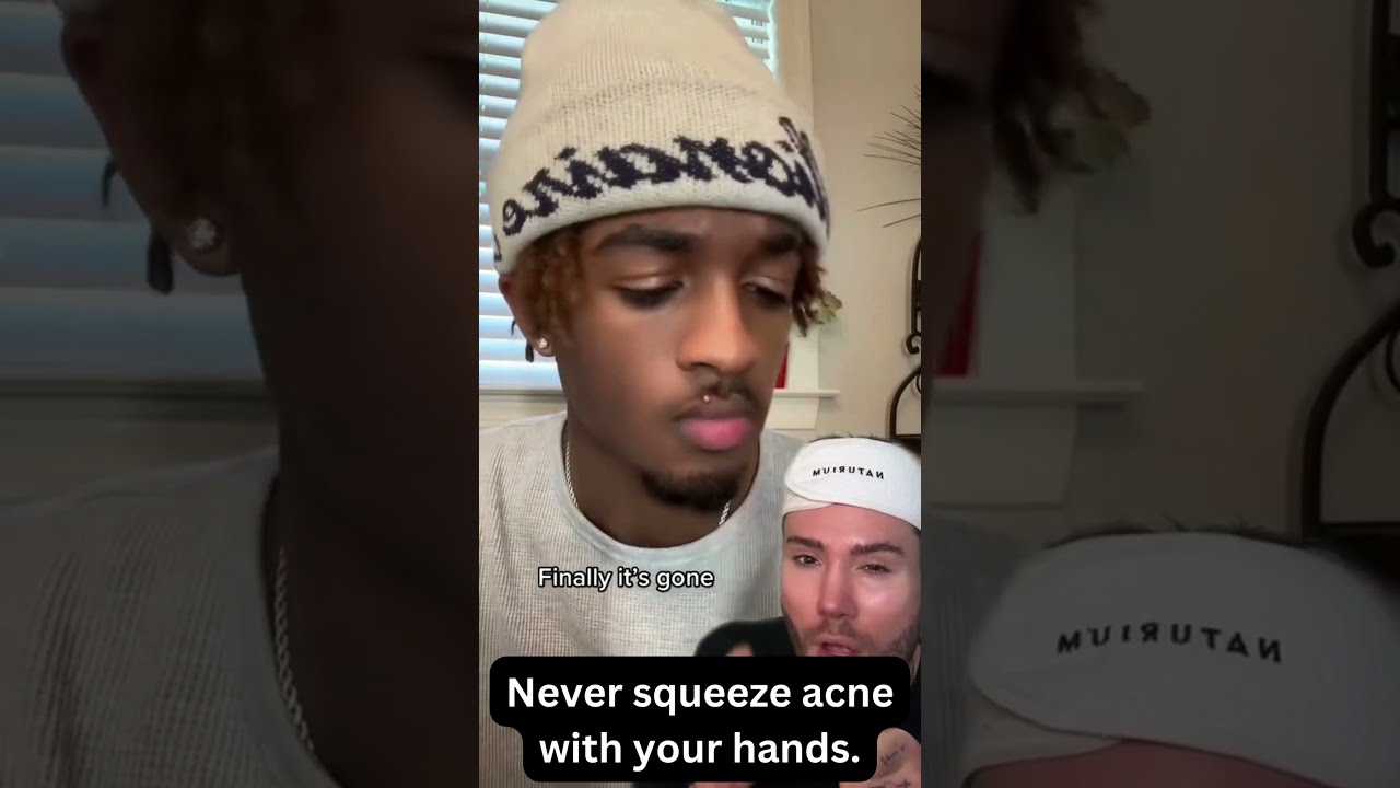 Never Squeeze Acne With Your Hands