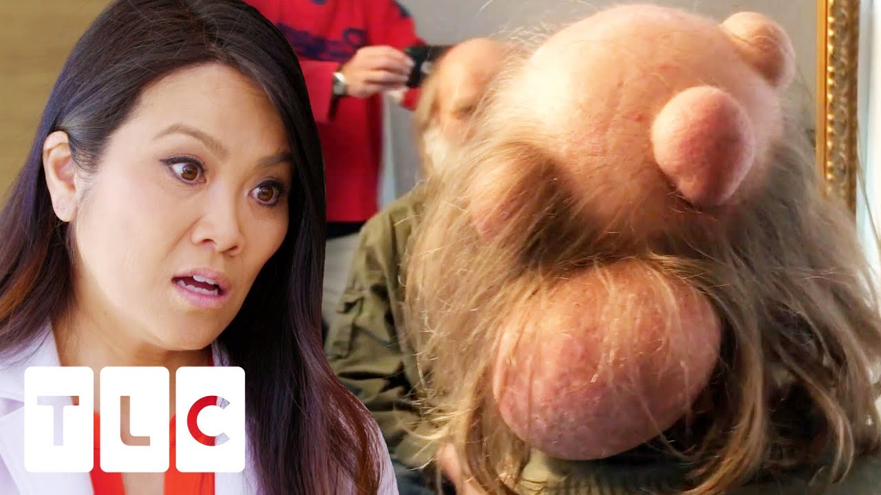 Slagter tyv edderkop Man Probably Has The Biggest Pilar Cyst Dr Lee Has Ever Seen | Dr. Pimple  Popper: Before The Pop - YouTube