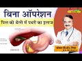           how are gall stones treated