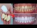 Sadece 2 dakikada inci gibi beyaz ve parlak dişleri beyazlatma sırrı, 3 doğal tarif / evde tedavi