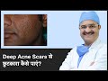 How To Get Rid Of Deep Acne Scars(Deep Acne Scars से छुटकारा कैसे पाएं)| ClearSkin, Pune| (In HINDI)