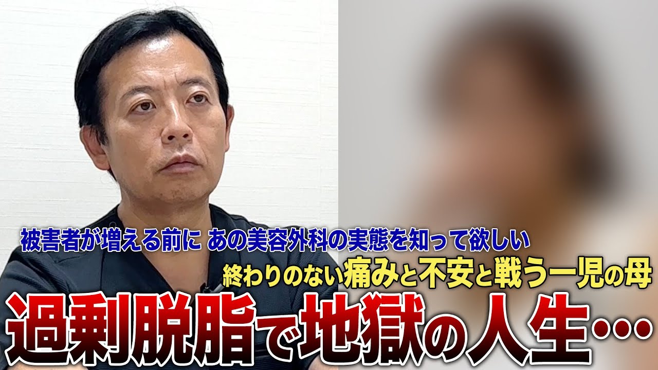 【クマ治療Gメン水谷】許せない！「眼窩脂肪の過剰脱脂」被害者の方にインタビュー