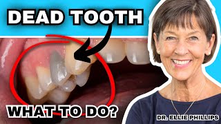 How a Tooth Can Die and What To Do About It