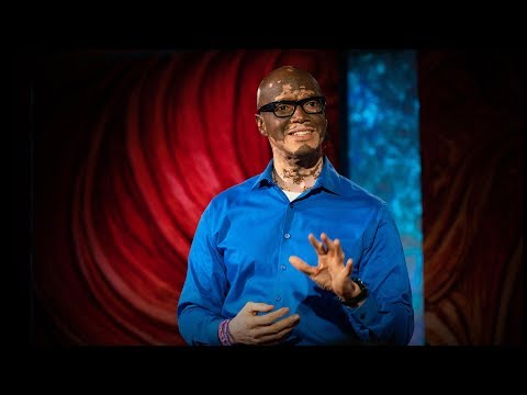 How I help people understand vitiligo | Lee Thomas