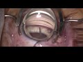 Comparison Of Outcomes Of Circumferential Trabeculotomy Vs Sectoral Excisional Goniotomy Comparison Of Outcomes Of Circumferential Trabeculotomy Vs Sectoral Excisional Goniotomy