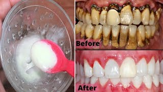 2 मिनट- दाँतों(Teeth) का पीलापन दूर कर मोती जैसे सफेद और चमकदार बना दे | Teeth whitening home remedy