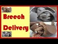 Breech delivery  mechanism of labour in breech presentation