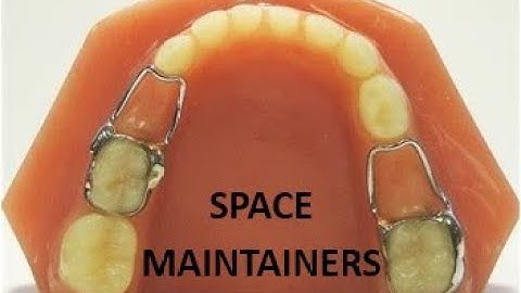 Band & loop Space Maintainer  Soldering Application