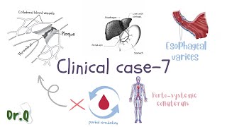 Clinical Case On Esophageal Varices Clinical Case-7 Porto-Systemic Collaterals