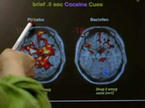 Baclofen dramatically reduces cocaine craving