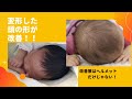 【変形した頭】の形が改善！！！BeforeAfter写真付で赤ちゃんの頭の変形を解説