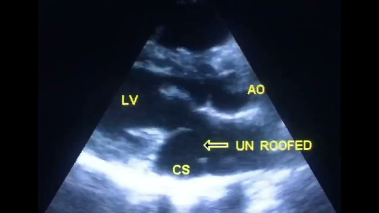 How to diagnose unroofed coronary sinus by echo