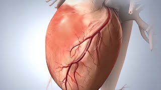 Medical Coding Tips -  Coding AMI - Myocardial Infarct ICD10 Diagnostic Codes