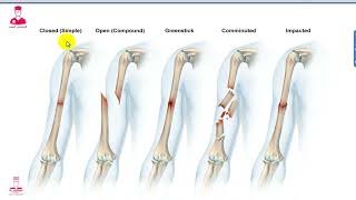 أنواع الكسور وكيف يلتئم العظام || TYPES OF FRACTURES