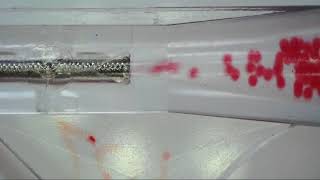 Microspheresbeads During Embolization