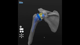 Reverse Shoulder Surgery Video with Peter Johnston, MD