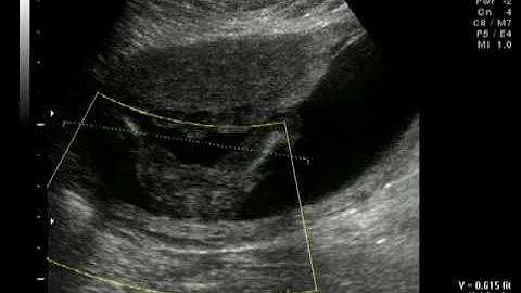 Gina LaBarbera's 17 Week Ultrasound - Part 3 - 3D ...