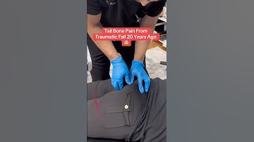 Interne staartbeencorrectie voor 20 jaar pijn