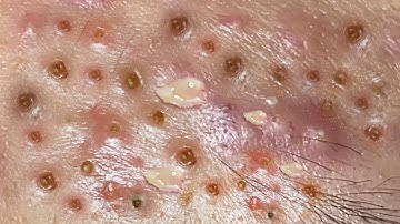 Loan Nguyen Acne Treatment 15155